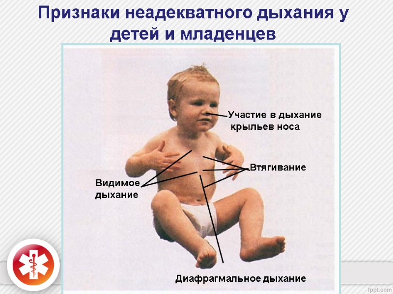 Признаки неадекватного дыхания у детей и младенцев Втягивание Видимое дыхание Диафрагмальное дыхание Участие в